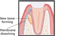 Diagram showing new bone forming and the membrane dissolving