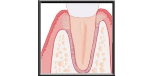 Diagram showing the healed area