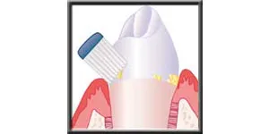 Diagram showing the proper toothbrushing angle