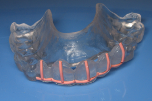 Radiographic guide with markings for the incisal edges and the long axis of missing teeth