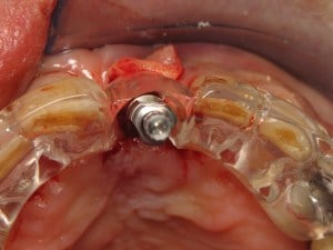 Surgical guide in place with pick-up coping