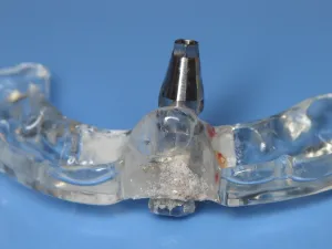 Impression coping attached to surgical guide