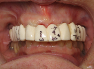 Barium surgical guide in a patient's mouth