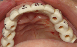 Barium surgical guide in a patient's mouth