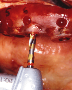 Materialize® surgical guide in place during surgery