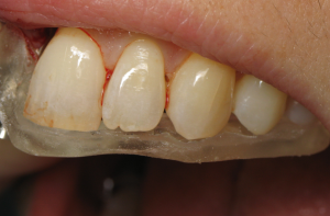 Poorly fitting tooth supported surgical guide